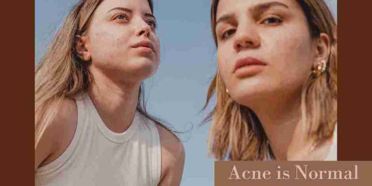 Is Acne Normal?