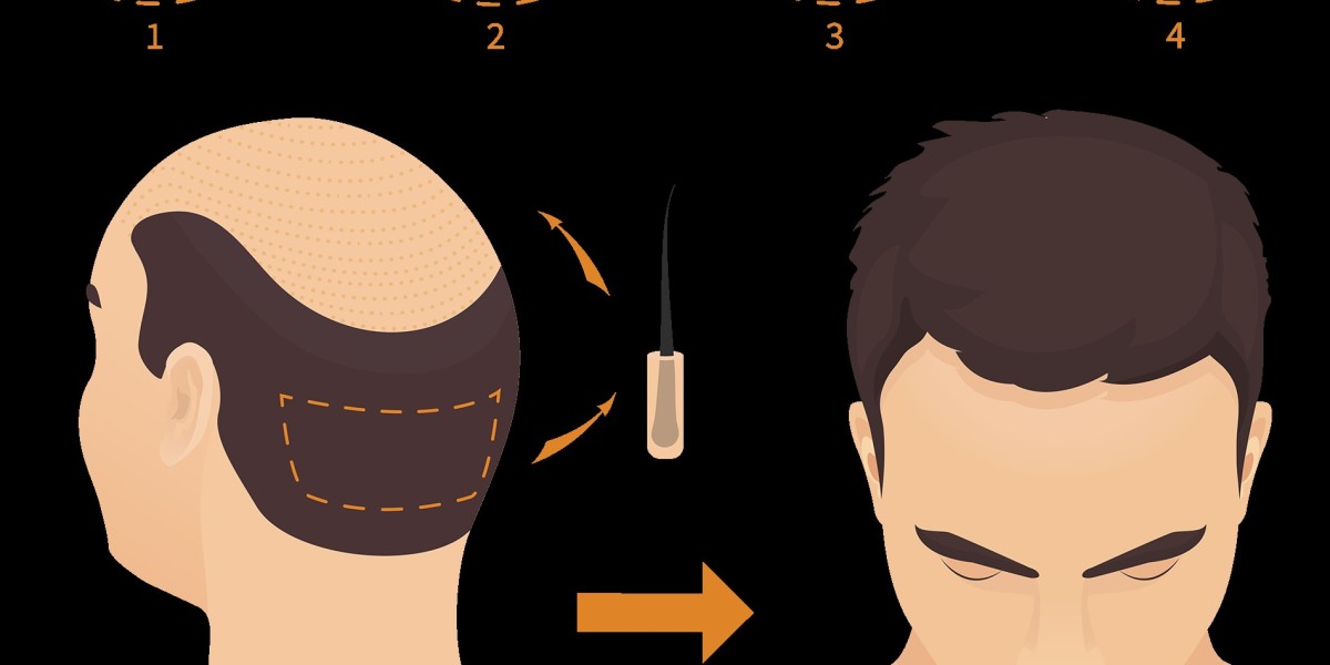 Real-Life FUE Hair Transplant Before and After Stories