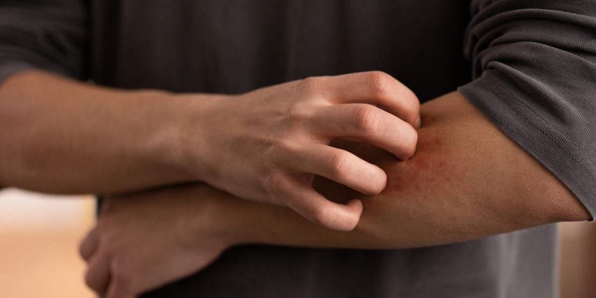 Winter Isn’t the Only Trigger: Everyday Situations That Can Spark Cold Urticaria