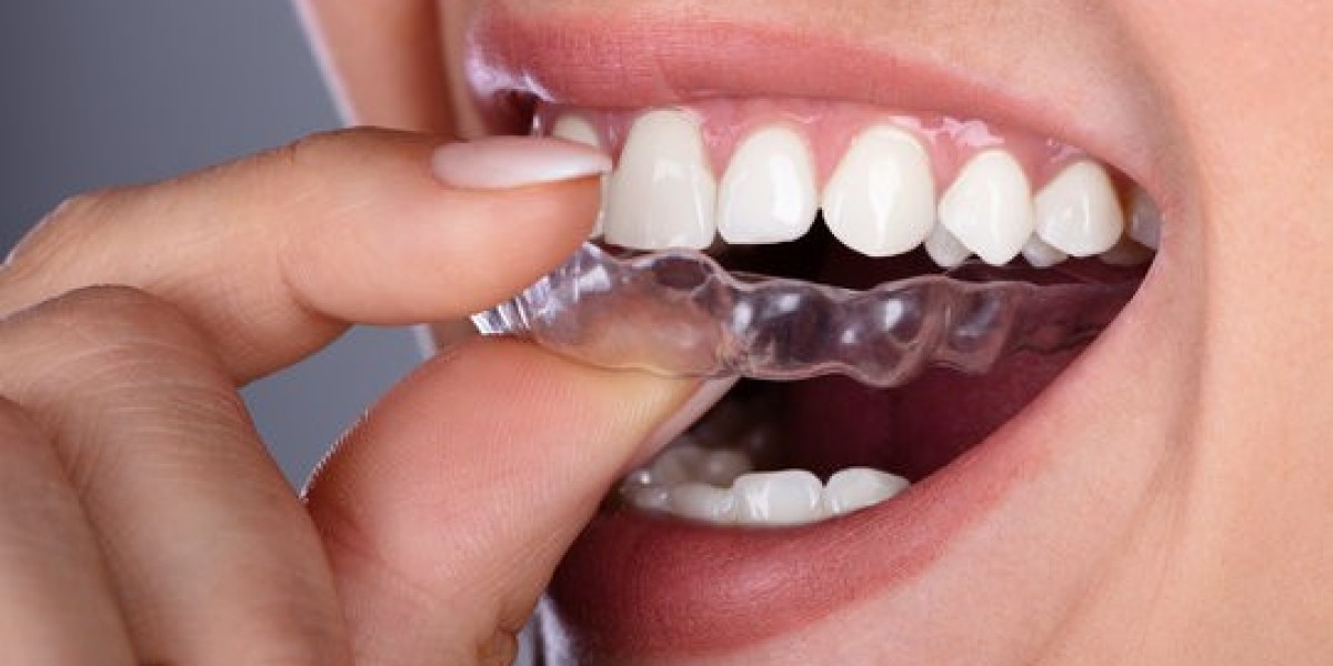 Teeth Aligners – Professional Smile Makeover