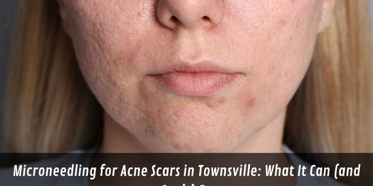 Microneedling for Acne Scars in Townsville: What It Can (and Can’t) Do