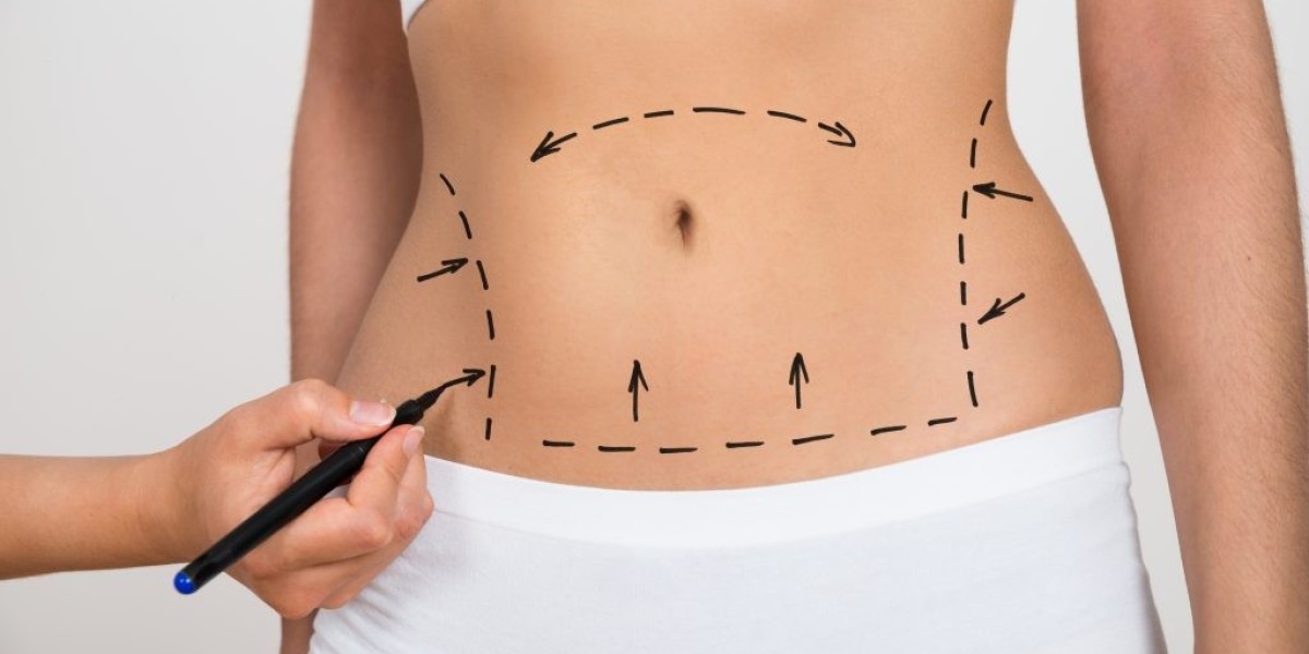 Fat Reduction Liposuction in Islamabad – Effective Results