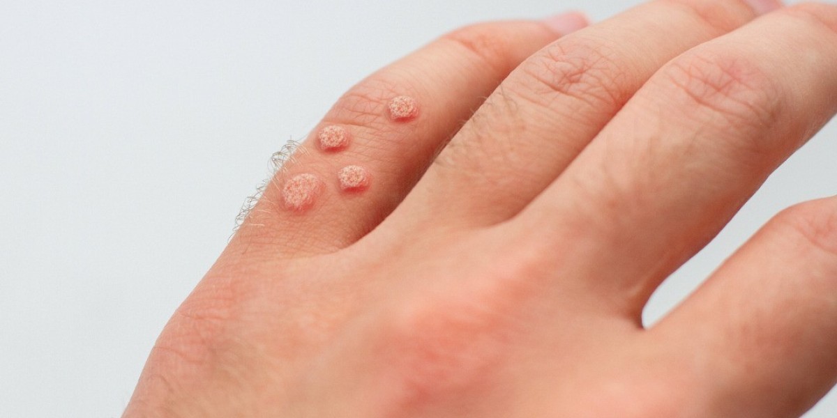 Skincare Routine After Wart Removal