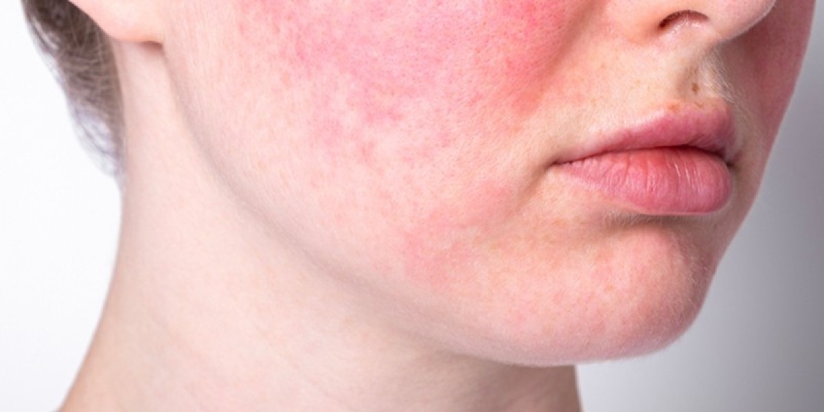 Papulopustular Rosacea Triggers and Effective Treatment Options