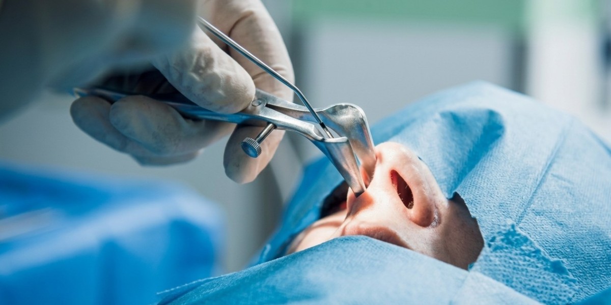 Septal Perforation Treatment Restoring Comfort and Nasal Function